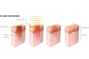 NUBWAY | что такое аппарат IPL? NUBWAY | что такое аппарат IPL?